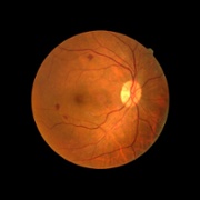 diabetic retinopathy R2