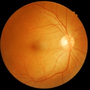 background (some) diabetic retinopathy