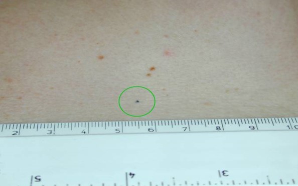 Radiotherapy ink dot mark