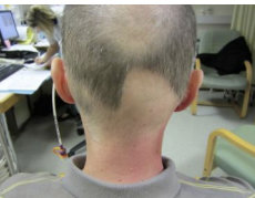 Patient with some hair loss