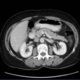 CT image of chest