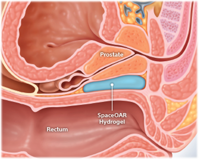 A diagram of the human body, showing where the SpaceOAR Hydrogel would be inserted.
