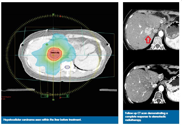 Radiotherapy SBRT scan