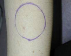 Area of skin circled with felt pen