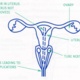 Radiotherapy gynaecological diagram