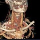 Head and Neck CT image