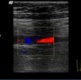 Ultrasound Doppler image