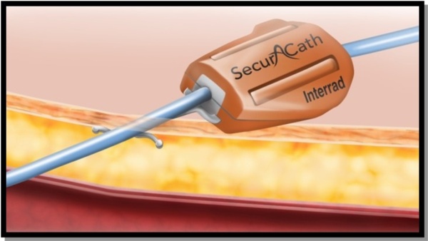 Image of Securacath device
