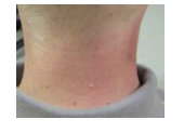 Person with a red and sore neck