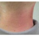 Person with a red and sore neck