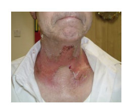 Person with blistered neck
