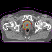 A CT image of a delineated prostate.
