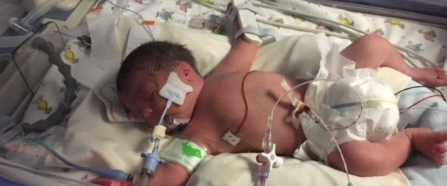 A small baby is receiving a blood transfusion.